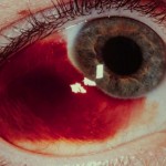 moderate blood on eye