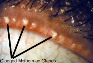 plugged meibomian glands